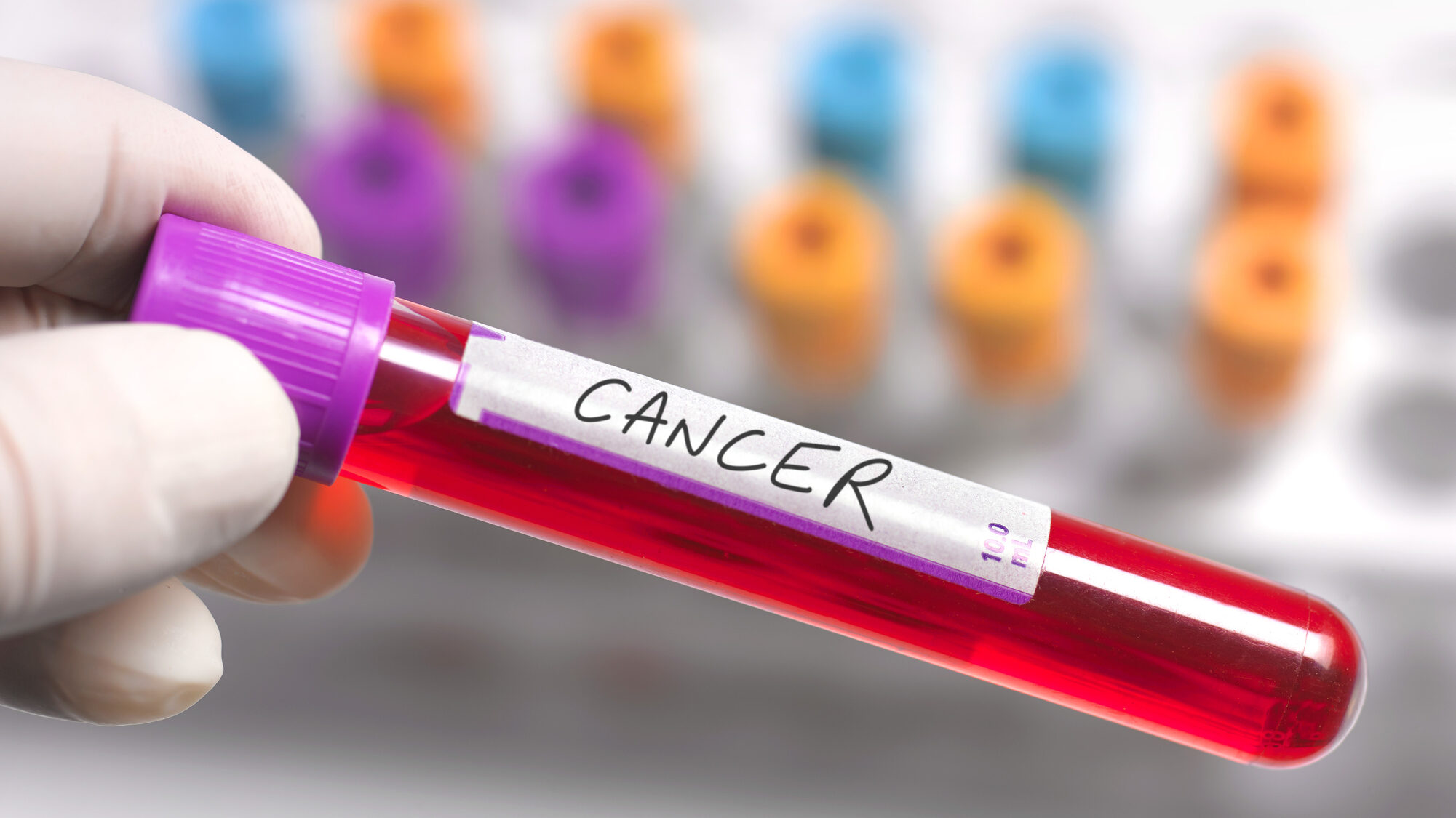 A Real Game Changer: Blood Test Catches Cancer Before a Tumor Appears ...