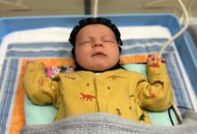 "swimming cap" invention for brain surgery on babies